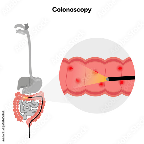 Colonoscopy diagram gastroscopy with endoscope 