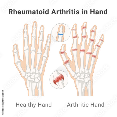 Rheumatoid arthritis of finger joint with details hand bone anatomy medical poster isometric vector