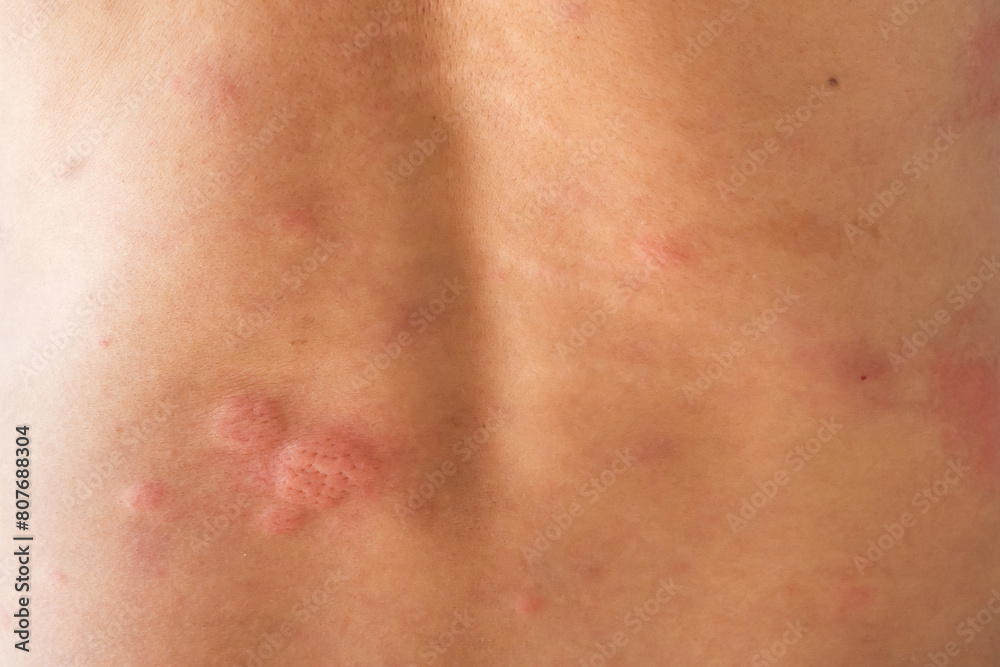 Young asian man itching and scratching on his back from allergic itchy dry skin eczema dermatitis insect bites