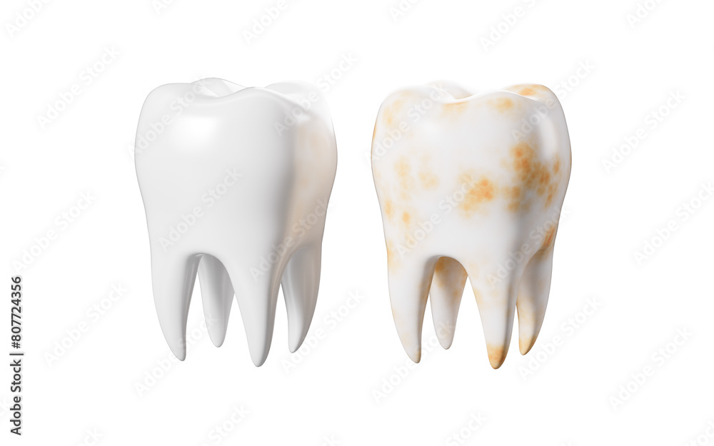 Human tooth model, tooth with plaque, unhealthy tooth, 3d rendering. Human tooth model, tooth with plaque, unhealthy tooth, 3d rendering.
