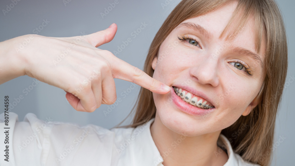 A beautiful red-haired girl smiles and points to the braces. Young woman corrects bite with orthodontic appliance A beautiful red-haired girl smiles and points to the braces. Young woman corrects bite with orthodontic appliance