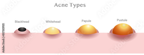 Acne type anatomy, diagram. Skin side view, blackhead, whitehead, papule, pustule. Facial skin problems. Vector illustration photo