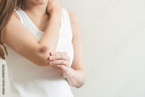 Close up of stain bruise wound on arm, contusion asian young woman, girl an accident fell down stairs, hand on elbow in healing injury by massage hematoma blood. Extravasation blue, purple on skin.