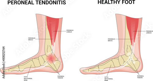 PERONEAL TENDONITIS Science Vector Illustration