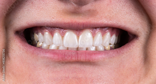 tooth restorations with emax ceramic crowns and veneers