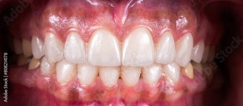 tooth restorations with emax ceramic crowns and veneers photo