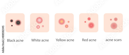 Illustration of various types of acne for web design and banners.
