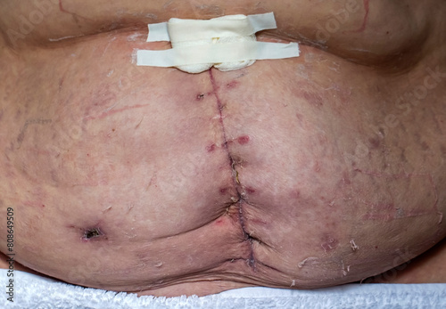 A stitch on the stomach after removal of the uterus and ovaries
