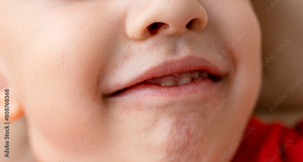 Close-up of a boy's face with red spots near the mouth, atopic dermatitis, allergies, rash and irritation Close-up of a boy's face with red spots near the mouth, atopic dermatitis, allergies, rash and irritation