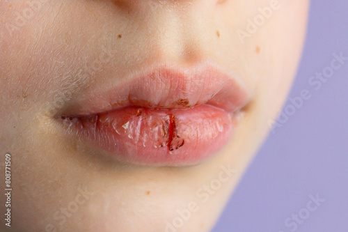 Close-up of a child with dry lips and a bloody lip crack. Lip care. Soft focus. Close-up
