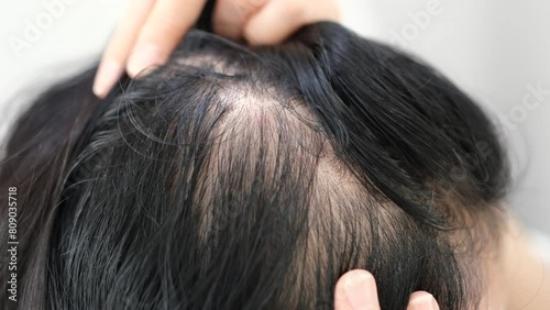 Asian woman parting her hair revealing hair loss or thinning hair.	