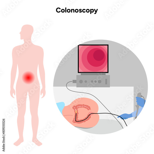 Colonoscopy procedure diagram gastroscopy with endoscope 