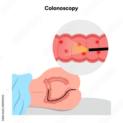 Colonoscopy procedure with patient zoom
