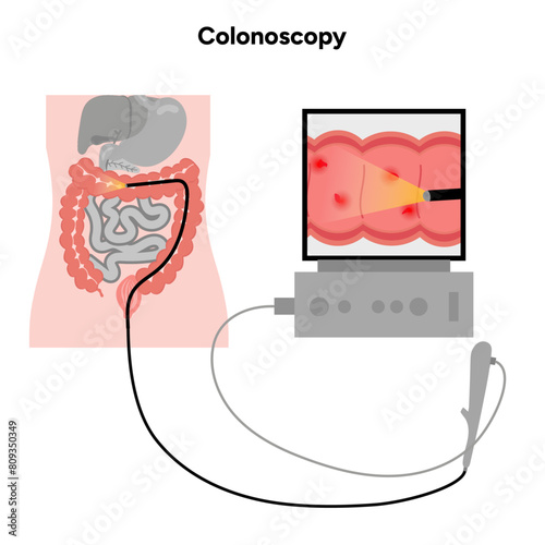 Colonoscopy and colonoscope
