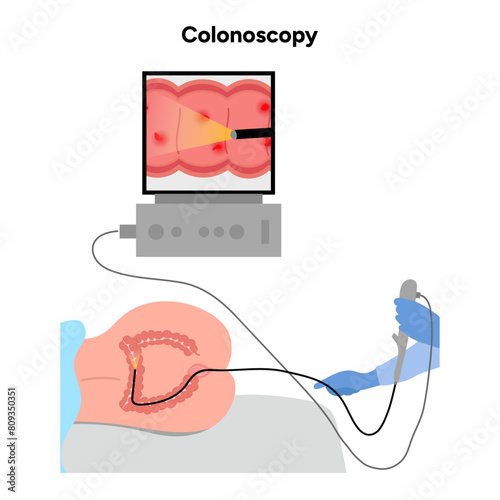 Colonoscopy and colonoscope