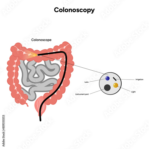 Colonoscopy and colonoscope