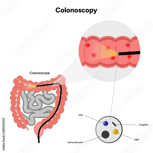 Colonoscopy and colonoscope