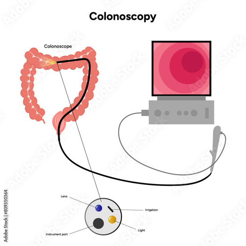 Colonoscopy and colonoscope