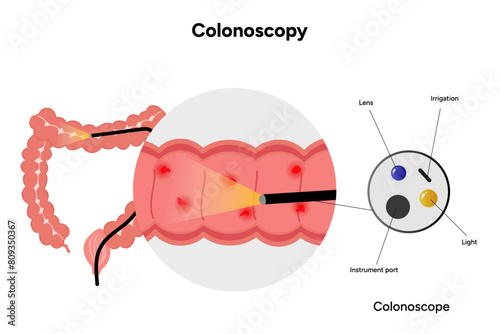 Colonoscopy and colonoscope