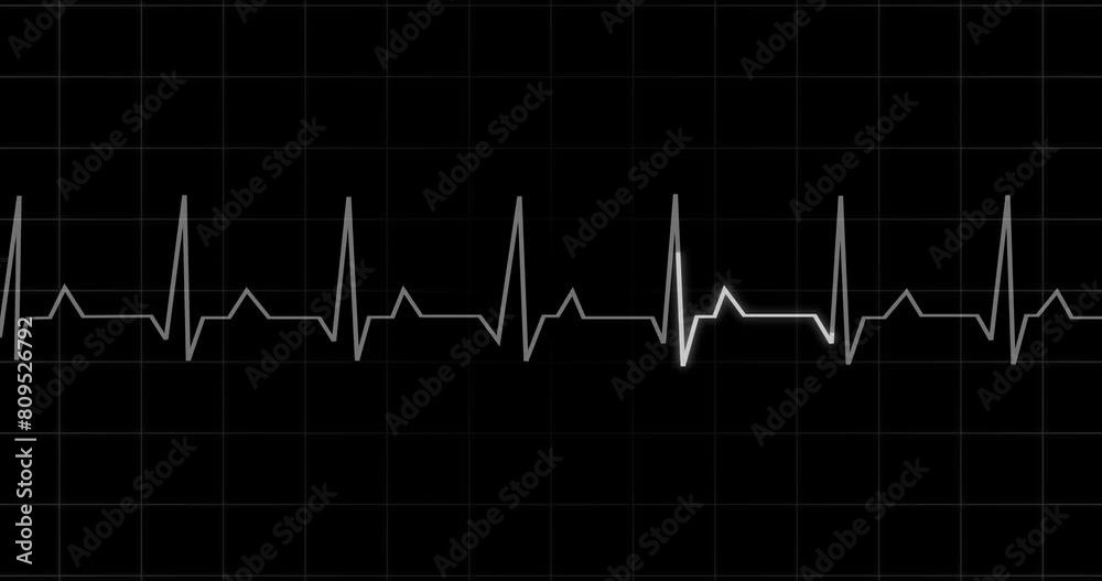 
EKG Heartbeat reading animation on black background in 4K. Medical monitor displaying cardiography pulse checkup diagnosis electronic screen display machine. Cardiogram nubes rate ecg waveform surger