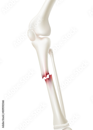 Close-up medical of shin bone fracture Used in medicine for treatment or for advertisements for specialized orthopedic hospitals. Realistic vector illustration.