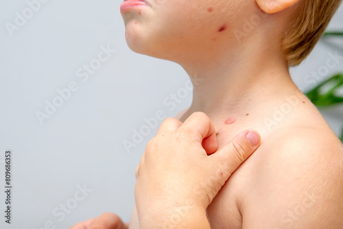Little boy scratching himself,rash on child body,Chickenpox,Varicella contagion virus, Enterovirus,Coxsackie,treatment of ulcers from bubble rash on kid skin photo