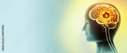 Tableau sur toile Medically accurate illustration of brain cancer