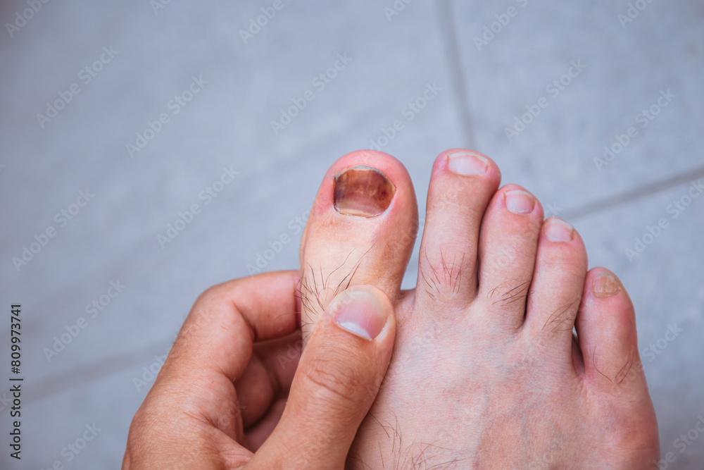 Basketball player common fracture. Male foot with toenail bruise after