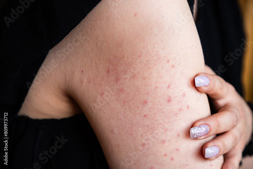 Red rash on the shoulder. Strawberry skin, long pastel pink nail design. Hand skin with atopic keratosis dermathology problem. 
