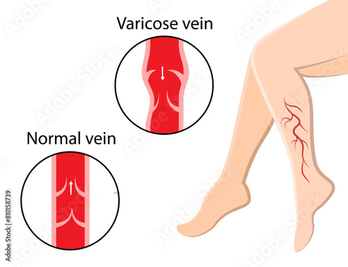 Varicose veins. Pain in the legs. Human Anatomy