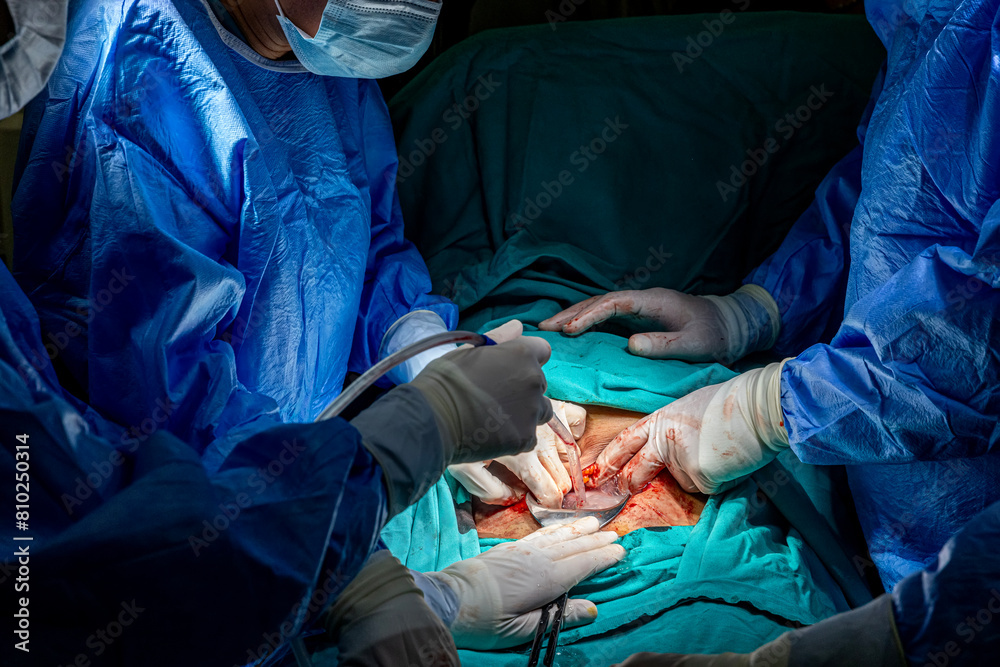 Surgeons performing cesarean section in operating room. Birth surgery with Caesarean. New life, baby being born via Caesarean Section in the operating room (mature content). Surgeons performing cesarean section in operating room. Birth surgery with Caesarean. New life, baby being born via Caesarean Section in the operating room (mature content).