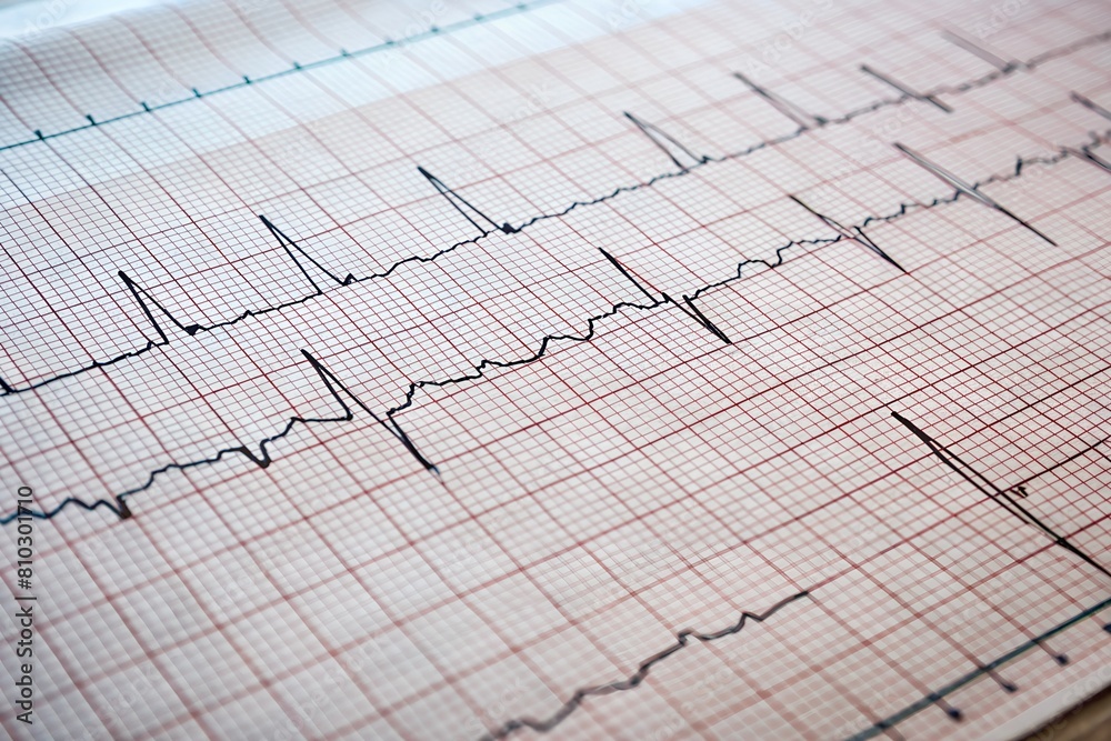 Close-up of an electrocardiogram printout with peaks and valleys, indicating heart rhythm and beats Close-up of an electrocardiogram printout with peaks and valleys, indicating heart rhythm and beats
