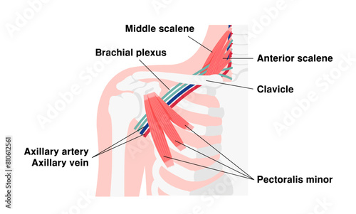 Vector illustration of where thoracic outlet syndrome occurs photo