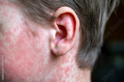 white Teenager covered in measles rash, infectious diseases.