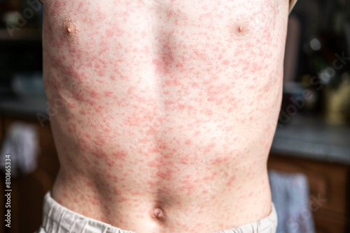 Cuadro en lienzo A person's body is covered in a rash, measles.