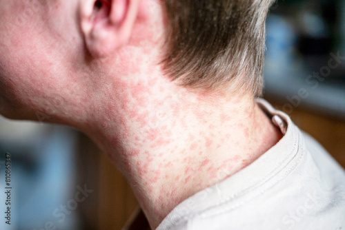 white Teenager covered in measles rash, infectious diseases.