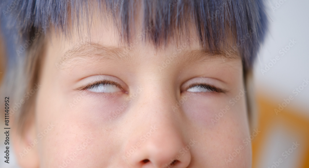 rolled eyes, close up part child face, boy 8 years old, human eye, diagnosis, treatment ophthalmic diseases, eyelids, emotional development children rolled eyes, close up part child face, boy 8 years old, human eye, diagnosis, treatment ophthalmic diseases, eyelids, emotional development children