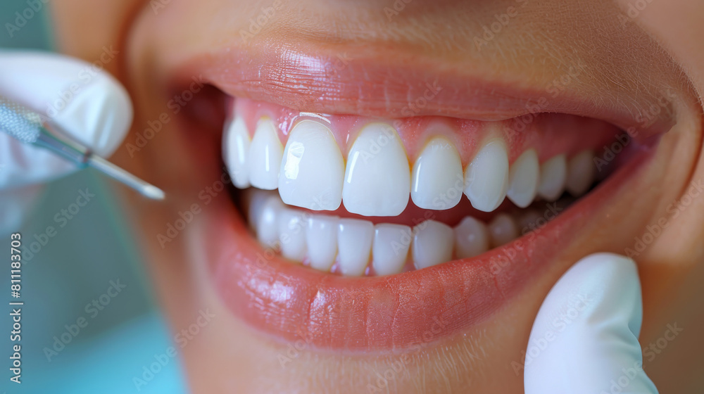 Fototapeta premium A close up of a woman with white teeth getting her mouth cleaned, AI