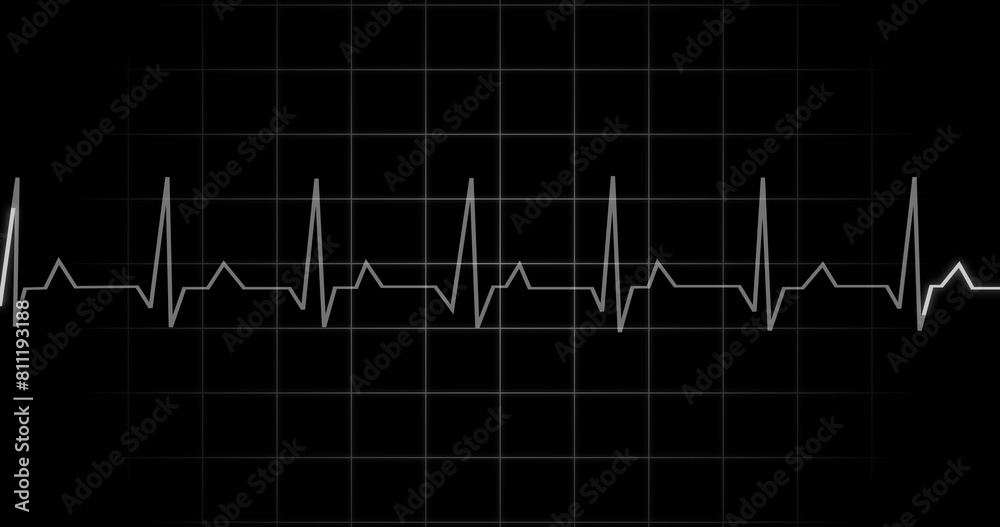 Naklejka premium EKG Heartbeat reading animation on black background. Medical monitor displaying cardiography pulse checkup diagnosis electronic screen display machine. Cardiogram nubes rate ecg waveform surgery.