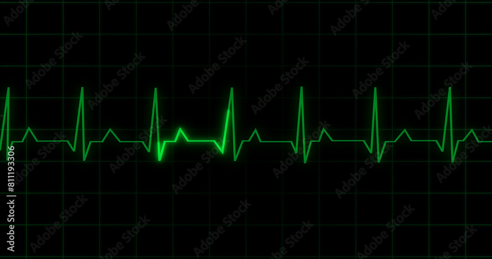 EKG Heartbeat reading animation on black background. Medical monitor displaying cardiography pulse checkup diagnosis electronic screen display machine. Cardiogram nubes rate ecg waveform surgery. EKG Heartbeat reading animation on black background. Medical monitor displaying cardiography pulse checkup diagnosis electronic screen display machine. Cardiogram nubes rate ecg waveform surgery.