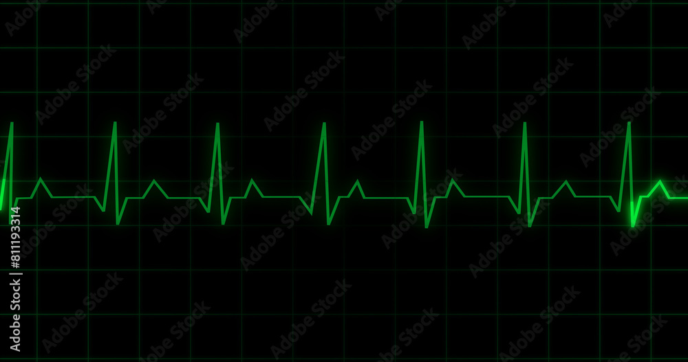 EKG Heartbeat reading animation on black background. Medical monitor displaying cardiography pulse checkup diagnosis electronic screen display machine. Cardiogram nubes rate ecg waveform surgery. EKG Heartbeat reading animation on black background. Medical monitor displaying cardiography pulse checkup diagnosis electronic screen display machine. Cardiogram nubes rate ecg waveform surgery.