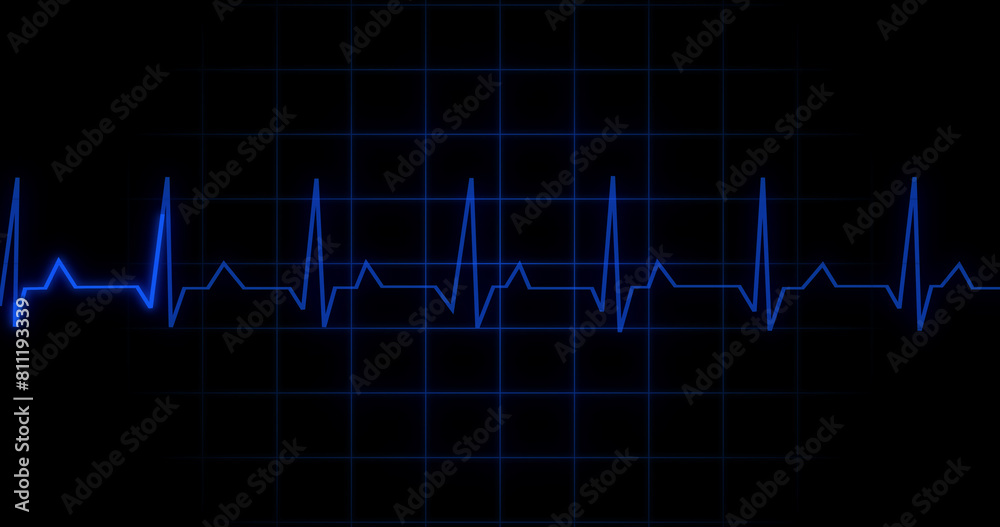 EKG Heartbeat reading animation on black background. Medical monitor displaying cardiography pulse checkup diagnosis electronic screen display machine. Cardiogram nubes rate ecg waveform surgery.