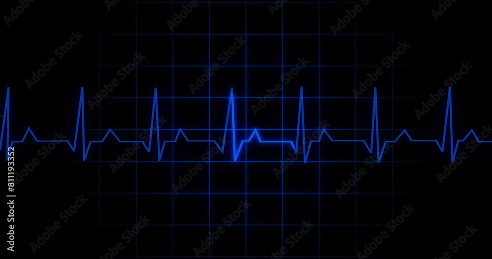 EKG Heartbeat reading animation on black background. Medical monitor displaying cardiography pulse checkup diagnosis electronic screen display machine. Cardiogram nubes rate ecg waveform surgery.