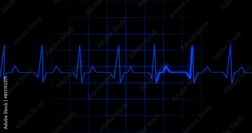 EKG Heartbeat reading animation on black background. Medical monitor displaying cardiography pulse checkup diagnosis electronic screen display machine. Cardiogram nubes rate ecg waveform surgery.