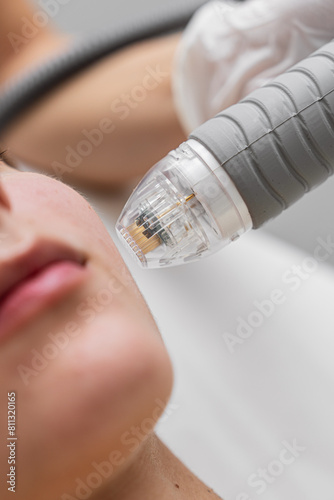 Microneedle RF lifting procedure. Hardware cosmetology.