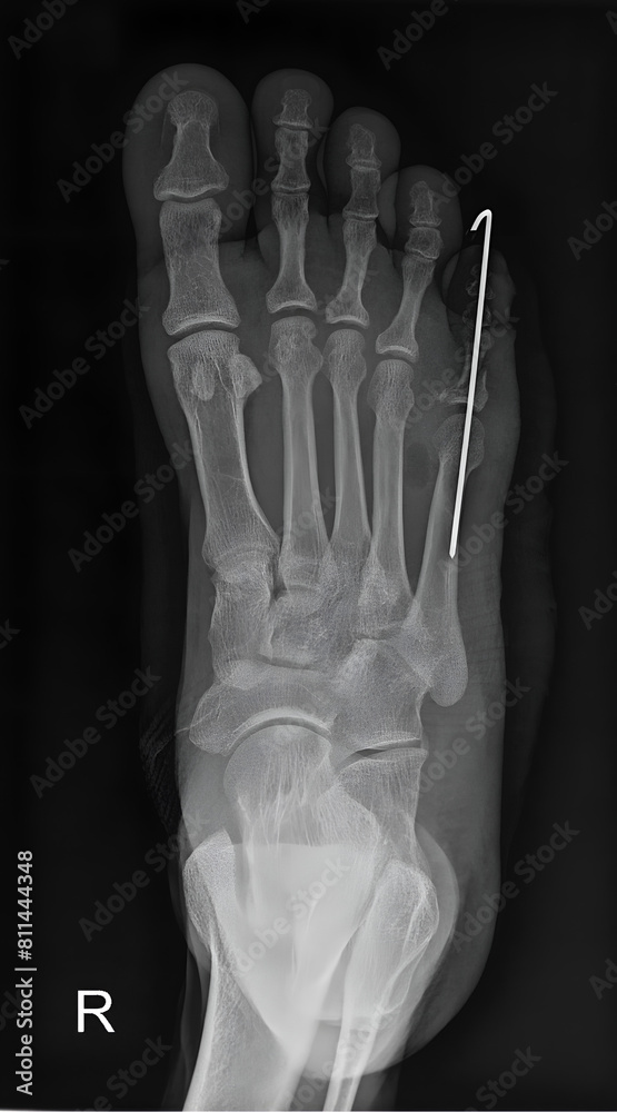 Metatarsal and Phalangeal Fracture Fixation: Radiographic Evaluation for Comprehensive Treatment Assessment