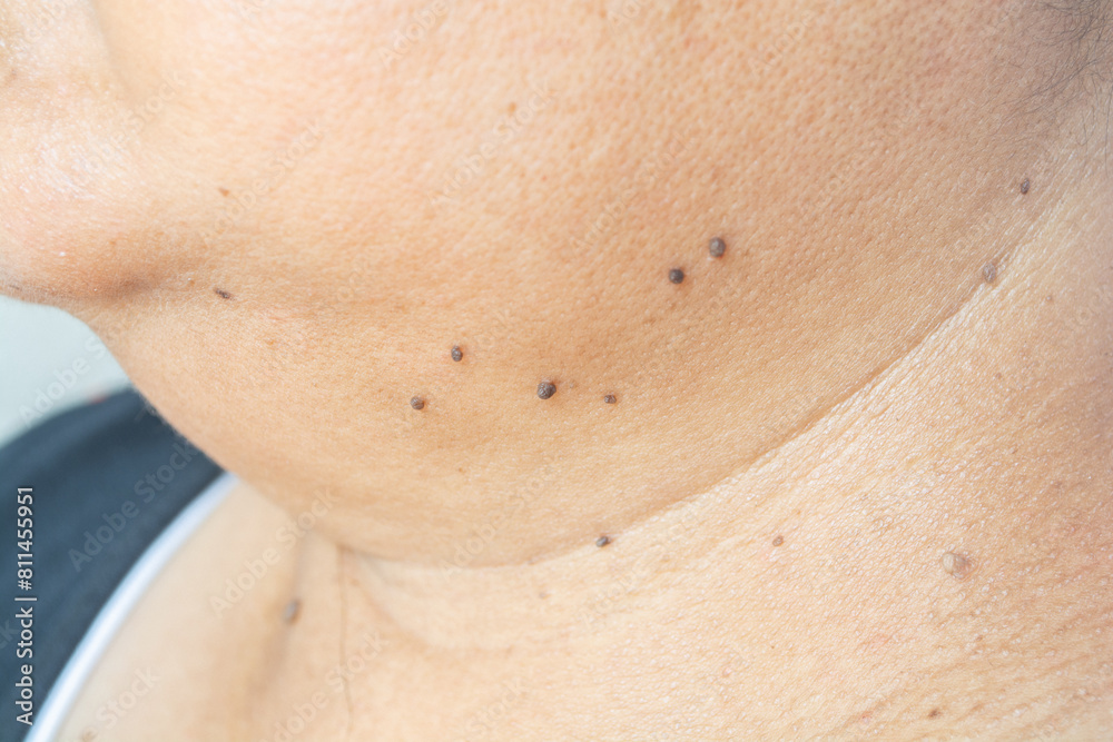 Fototapeta premium Skin tags on the neck It's a brown or black spot. On the skin of adults, it is treated with laser and surgery.