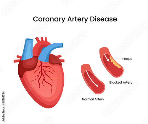 Coronary artery disease medical design