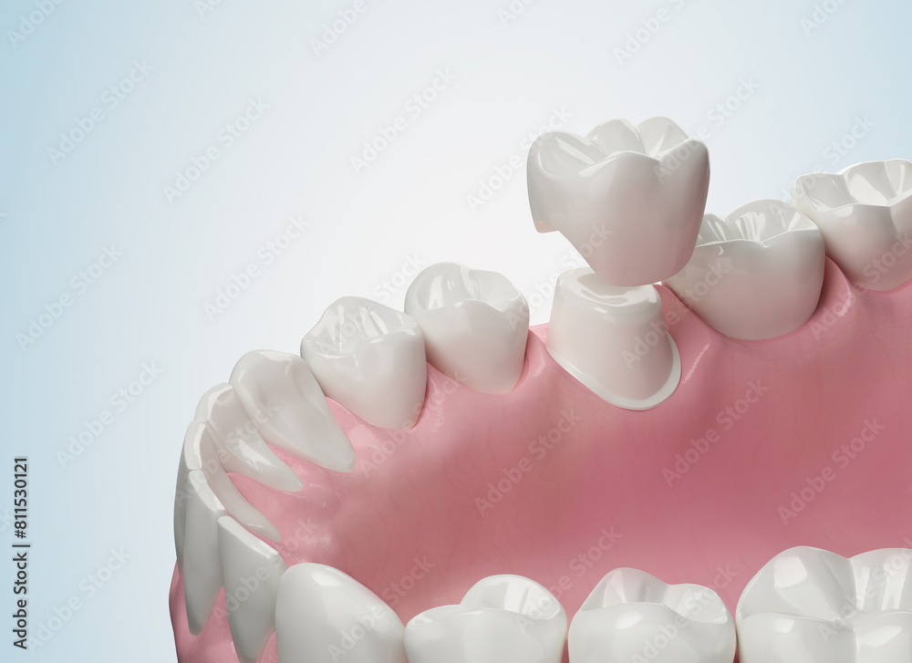 Dental crown, teeth installation isolate on white background, 3d illustration. Dental crown, teeth installation isolate on white background, 3d illustration.