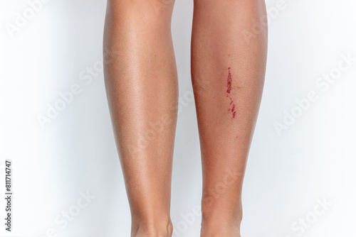 Female lower leg in front with a blow wound on a light background. Injured shin